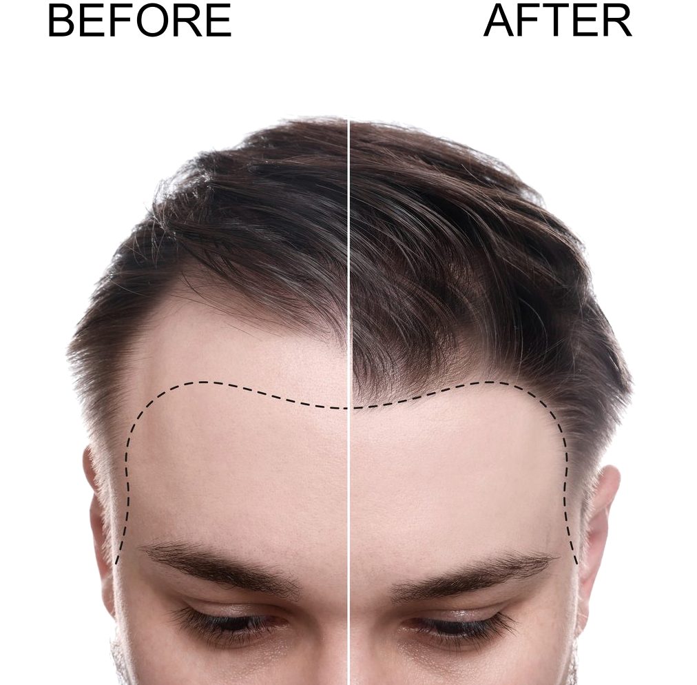 Hair transplant before and after illustration