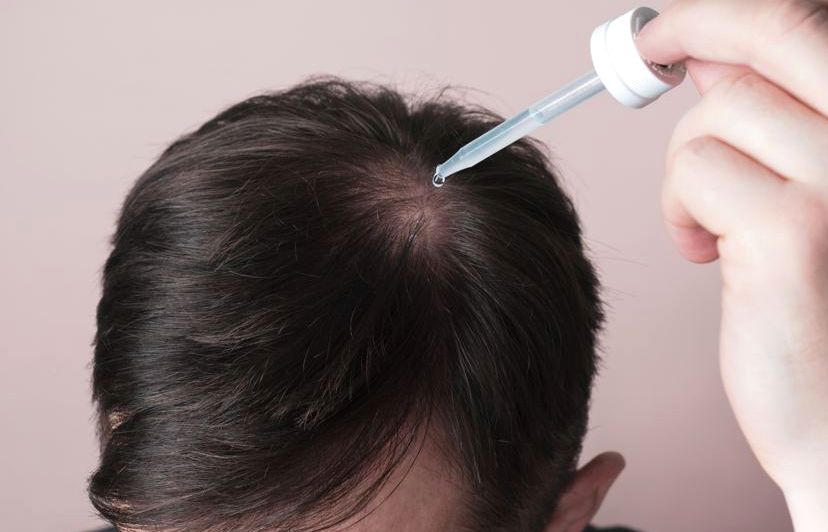 Applying a topical minoxidil and finasteride solution to the scalp with a dropper